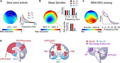 Local Sleep and Alzheimer’s Disease Pathophysiology